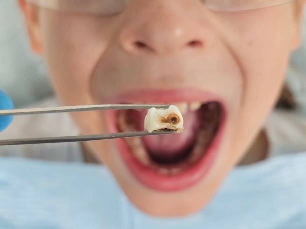 Best Emergency Dental Extractions in Holden, MO